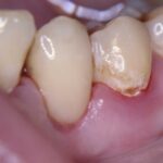 Лучшая имплантация зубов в СПб.
Классификация кариеса Лучшая имплантация зубов в СПб.
Классификация кариеса