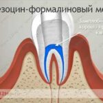 Лучшая имплантация зубов в СПб.
Резоцин-формалиновый метод Лучшая имплантация зубов в СПб.
Резоцин-формалиновый метод