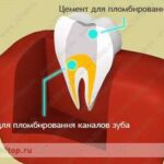 Лучшая имплантация зубов в СПб. 
 Пломбирование каналов зуба