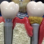 Лучшая имплантация зубов в СПб. Как не допустить развитие переимплантита Лучшая имплантация зубов в СПб. Как не допустить развитие переимплантита