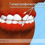 Лучшая имплантация зубов в СПб. 
 Гипертрофический гингивит