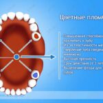 Лучшая имплантация зубов в СПб. 
 Цветные пломбы