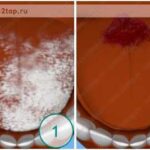 Лучшая имплантация зубов в СПб. 
 Глоссит языка