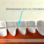 Лучшая имплантация зубов в СПб. 
 Шинирование зубов
