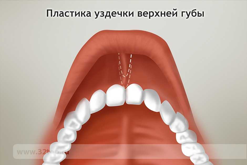 Фото Уздечки Языка Ребенка