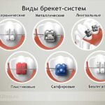 Лучшая имплантация зубов в СПб. 
 Брекет-системы