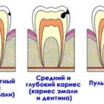Лучшая имплантация зубов в СПб. 
 Хронический периодонтит