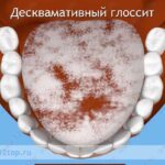 Лучшая имплантация зубов в СПб. 
 Десквамативный глоссит