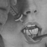 Лучшая имплантация зубов в СПб.
Применение инфильтрационной анестезии Лучшая имплантация зубов в СПб.
Применение инфильтрационной анестезии