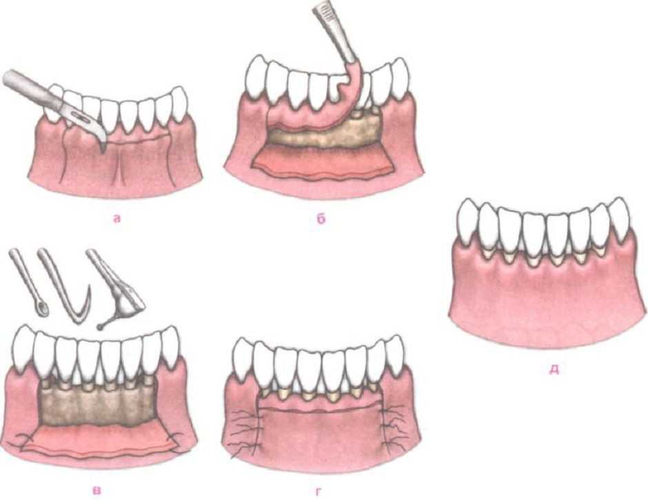 кюретаж свищевого хода. карман между зубом и десной. кюретаж пародонтальных карманов закрытый и открытый. карман между зубом и десной. кюретаж пародонтальных карманов.