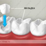 Лучшая имплантация зубов в СПб.
Культевая вкладка Лучшая имплантация зубов в СПб.
Культевая вкладка