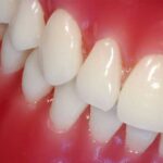 Лучшая имплантация зубов в СПб. 
 Лечение воспаления десен