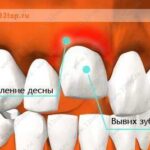 Лучшая имплантация зубов в СПб. 
 Вывих зуба