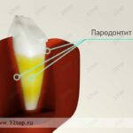 Лучшая имплантация зубов в СПб. 
 Способы лечения пародонтита